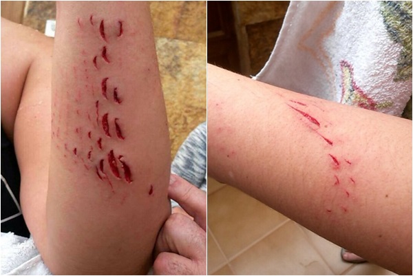 Imágenes de las heridas sufridas en el brazo por la bañista, doctora de profesión. | <a href=