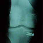 Clavos y tornillos son habituales cuando se exponen muchos pacientes a pruebas radiológicas.